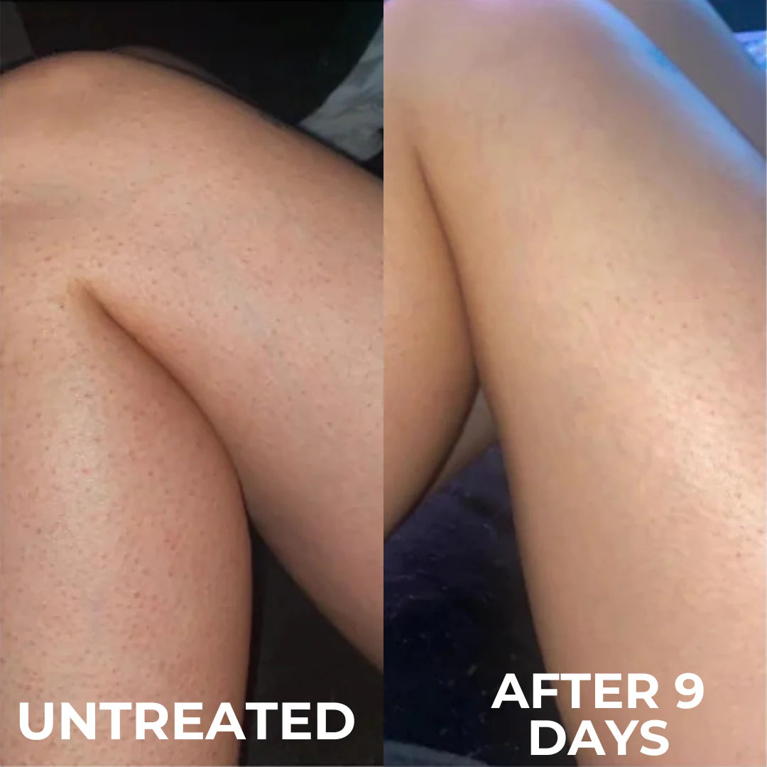 Aurolya Tumeric Peel Shot for Dead Skin & Keratosis Pilaris
