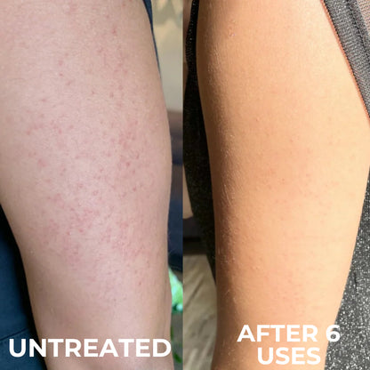 Aurolya Tumeric Peel Shot for Dead Skin & Keratosis Pilaris